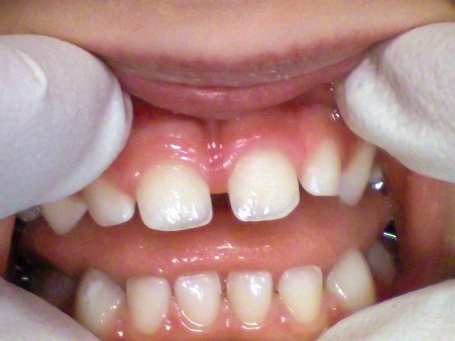 Frenectomy - 4 Months Later