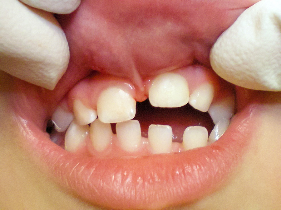 Frenectomy - 4 Months Later