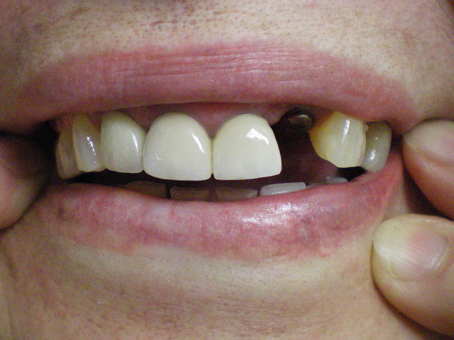 Implant - Crown Case 5 - After