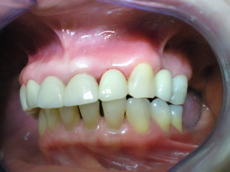 Implant - Crown Case 7 - After