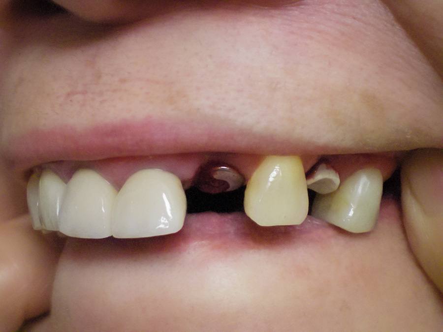 Implant - Crown Case 7 - After