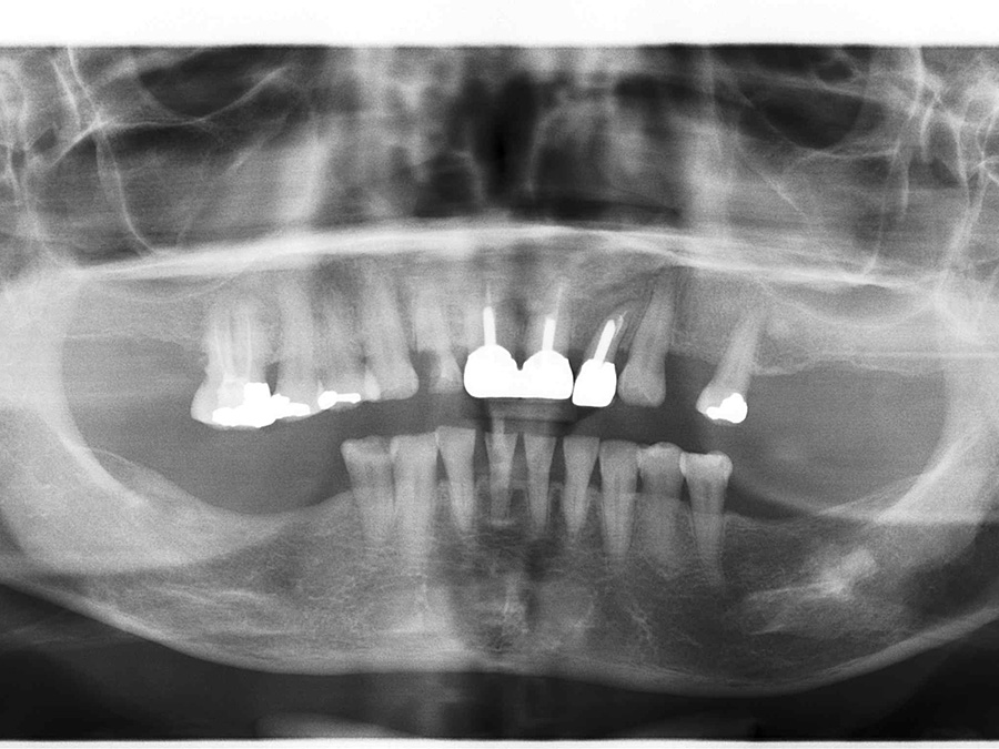 Implants Vo - After