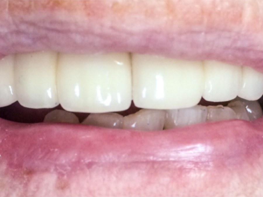 Frenectomy - 4 Months Later