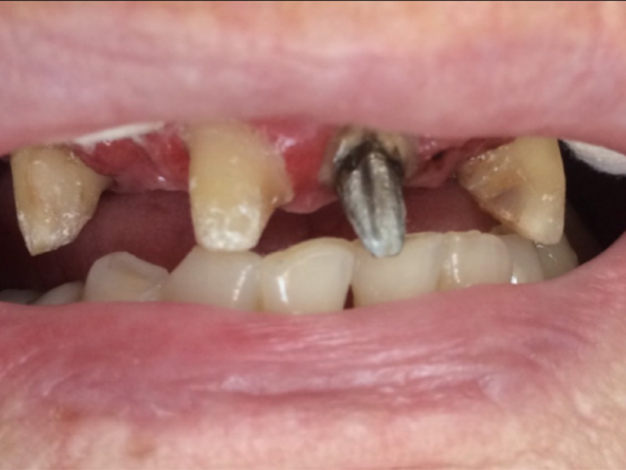 Frenectomy - 4 Months Later