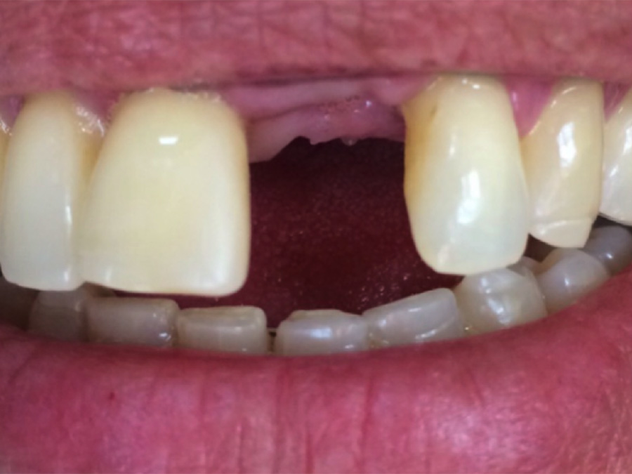 Frenectomy - 4 Months Later